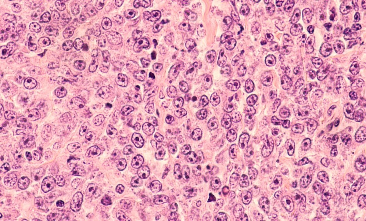 Photomicrograph of a diffuse large B-cell lymphoma | Image Credit: ©DavidALitman - stock.adobe.com