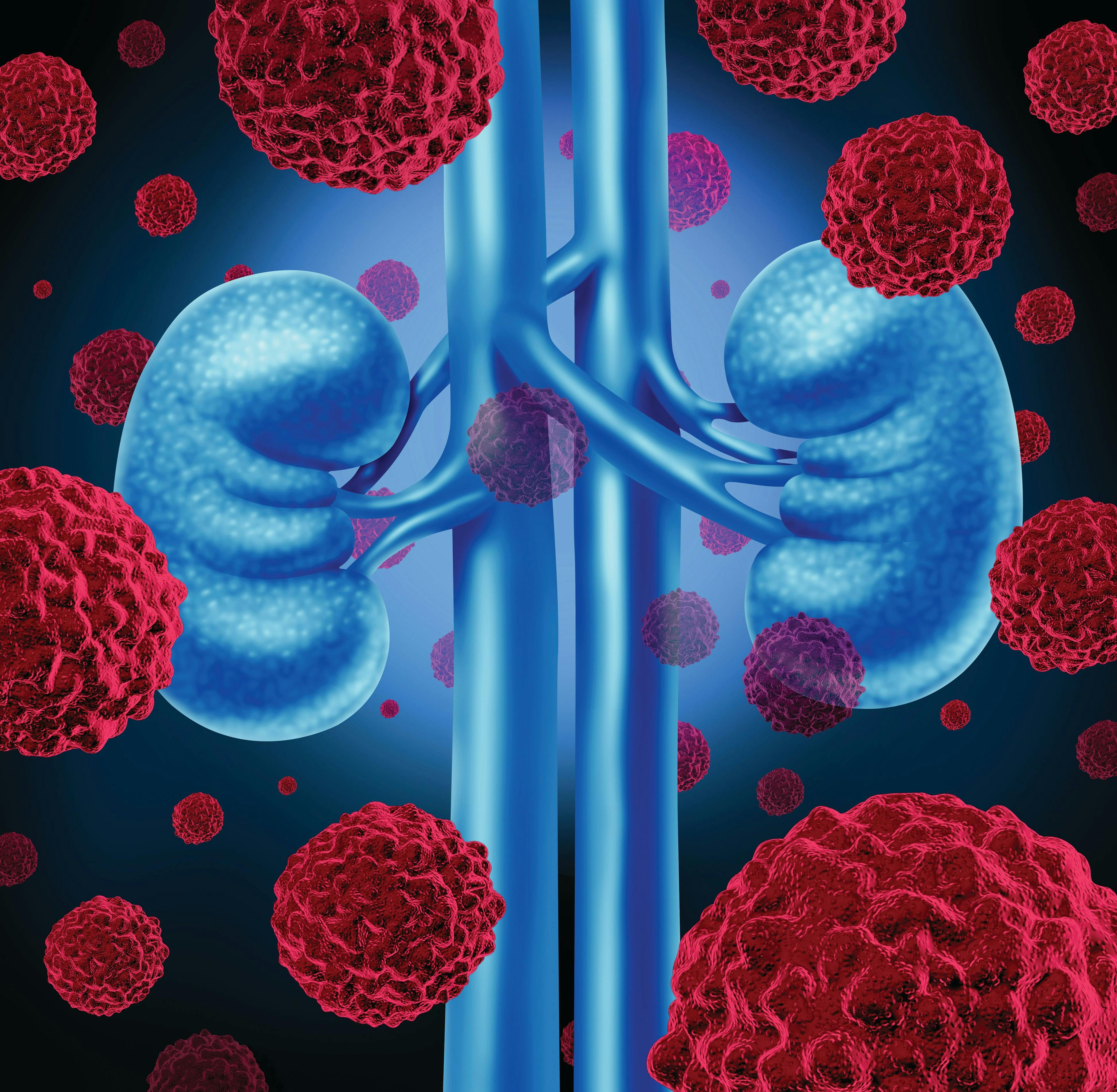 Iron Therapy May Help Broader Group of Patients With Kidney Disease