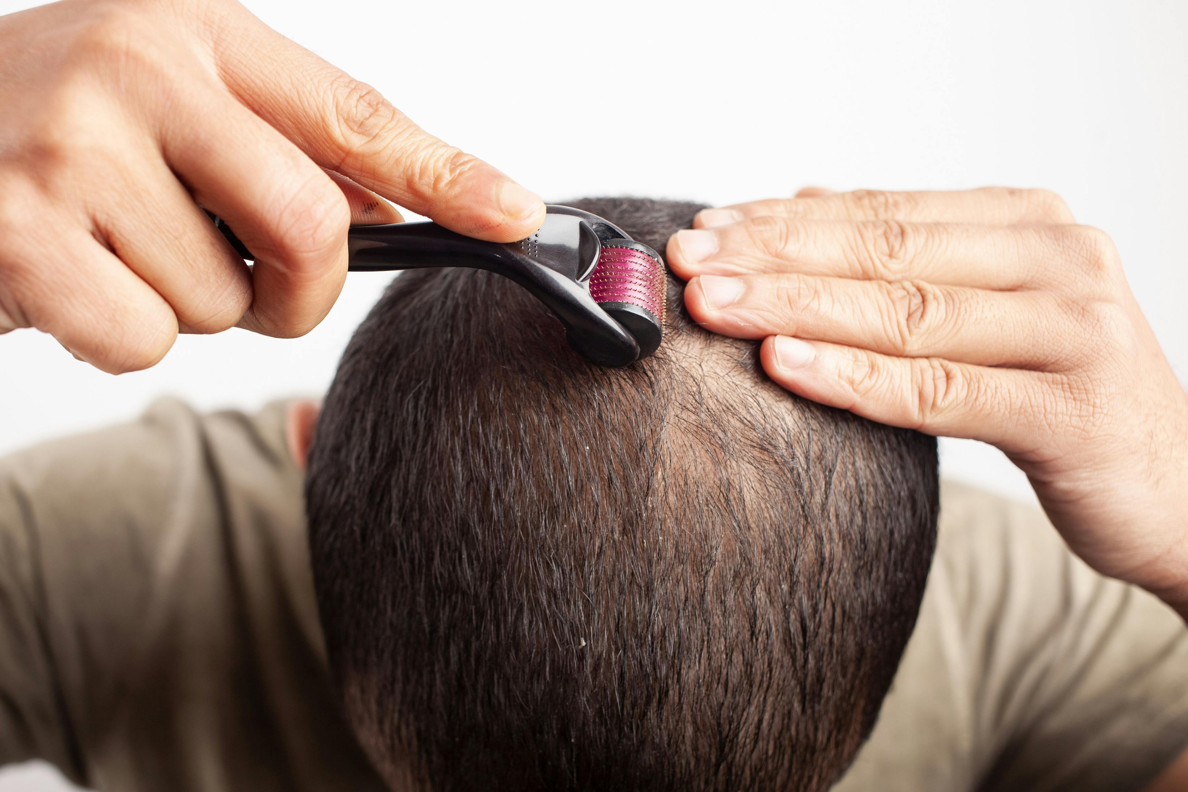 Microneedling hair loss treatment | Image Credit: Dharma - stock.adobe.com