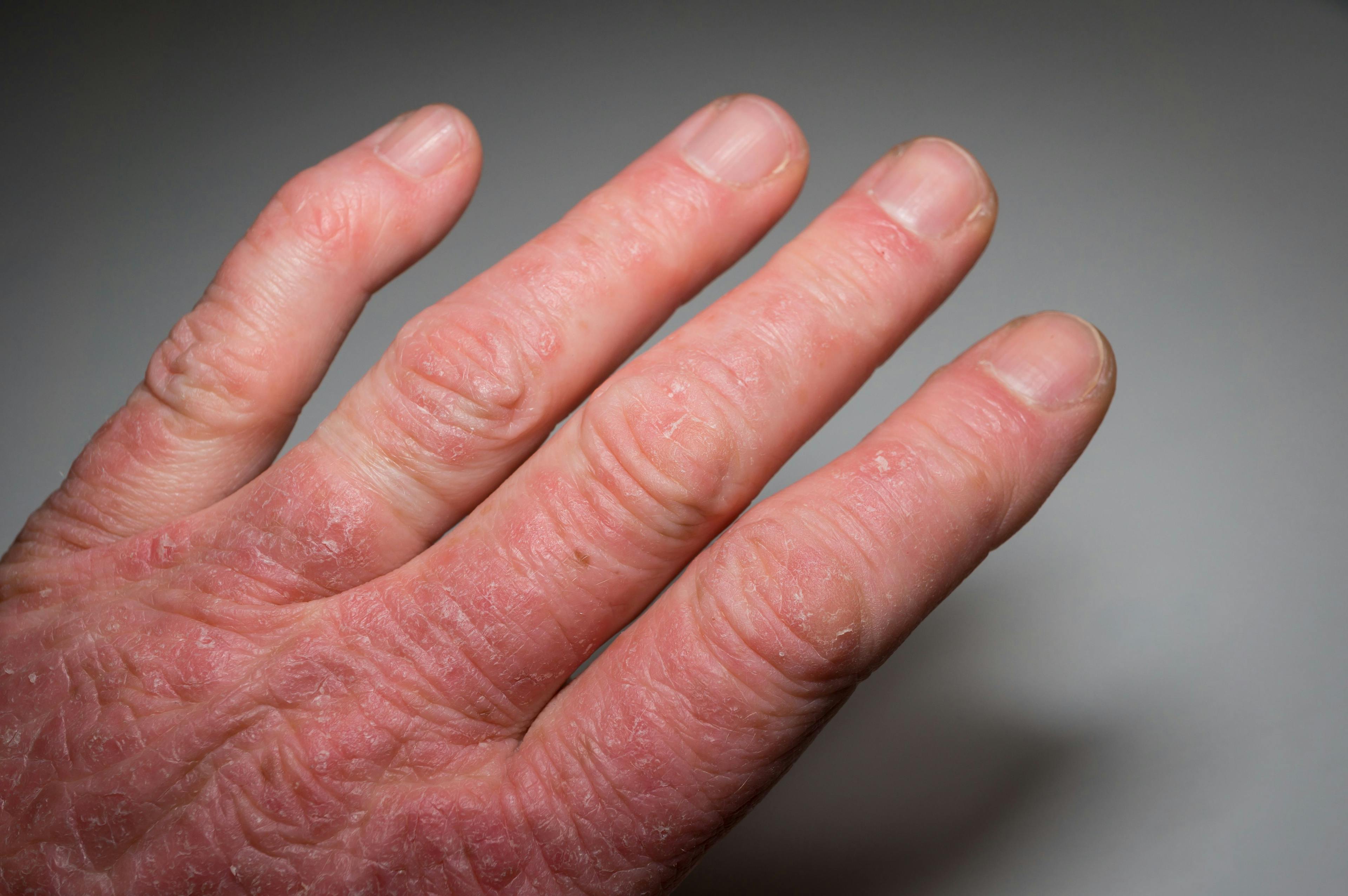 Hand with psoriasis rash