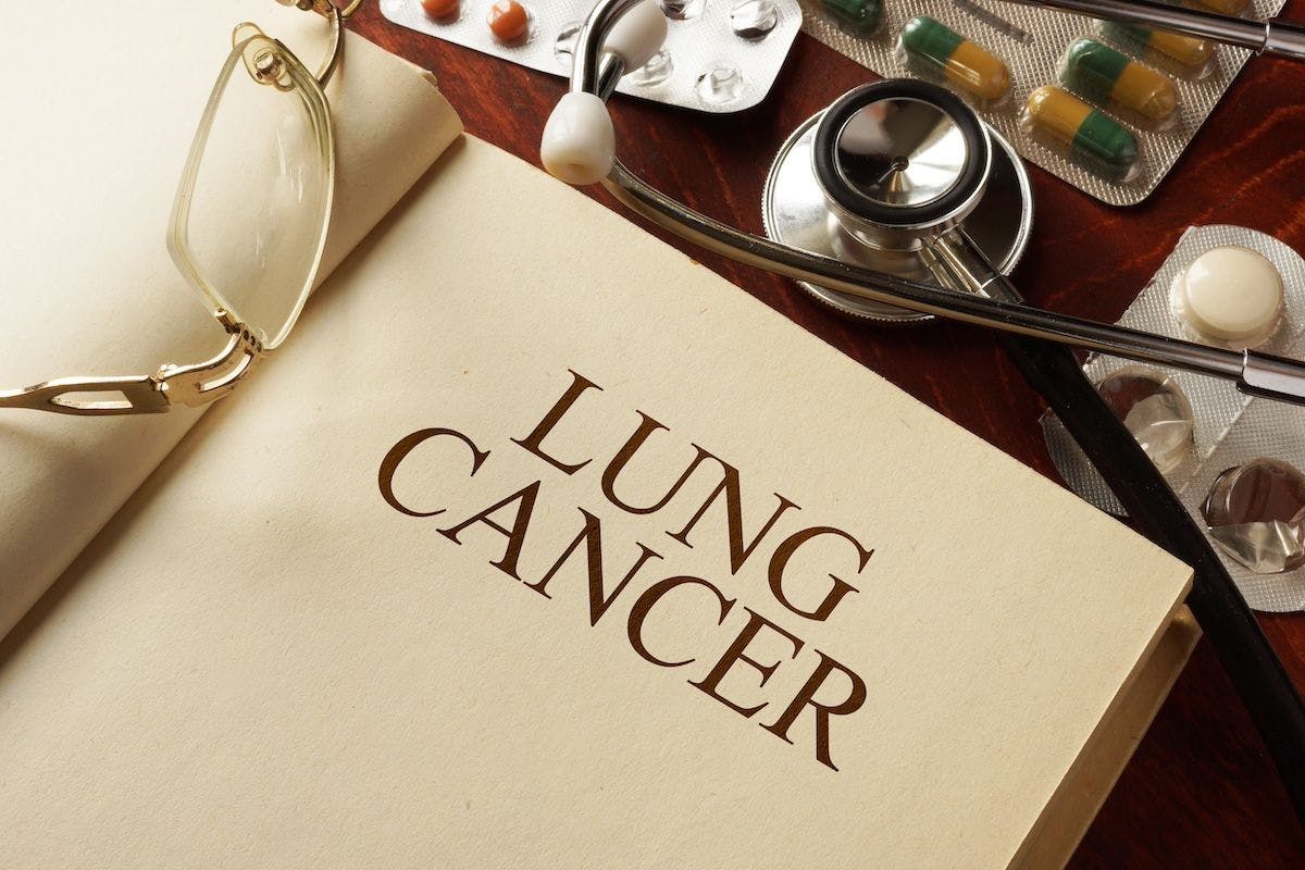 Lung cancer diagnosis concept | Image Credit: VitaliiVodolazskyi-stock.adobe.com