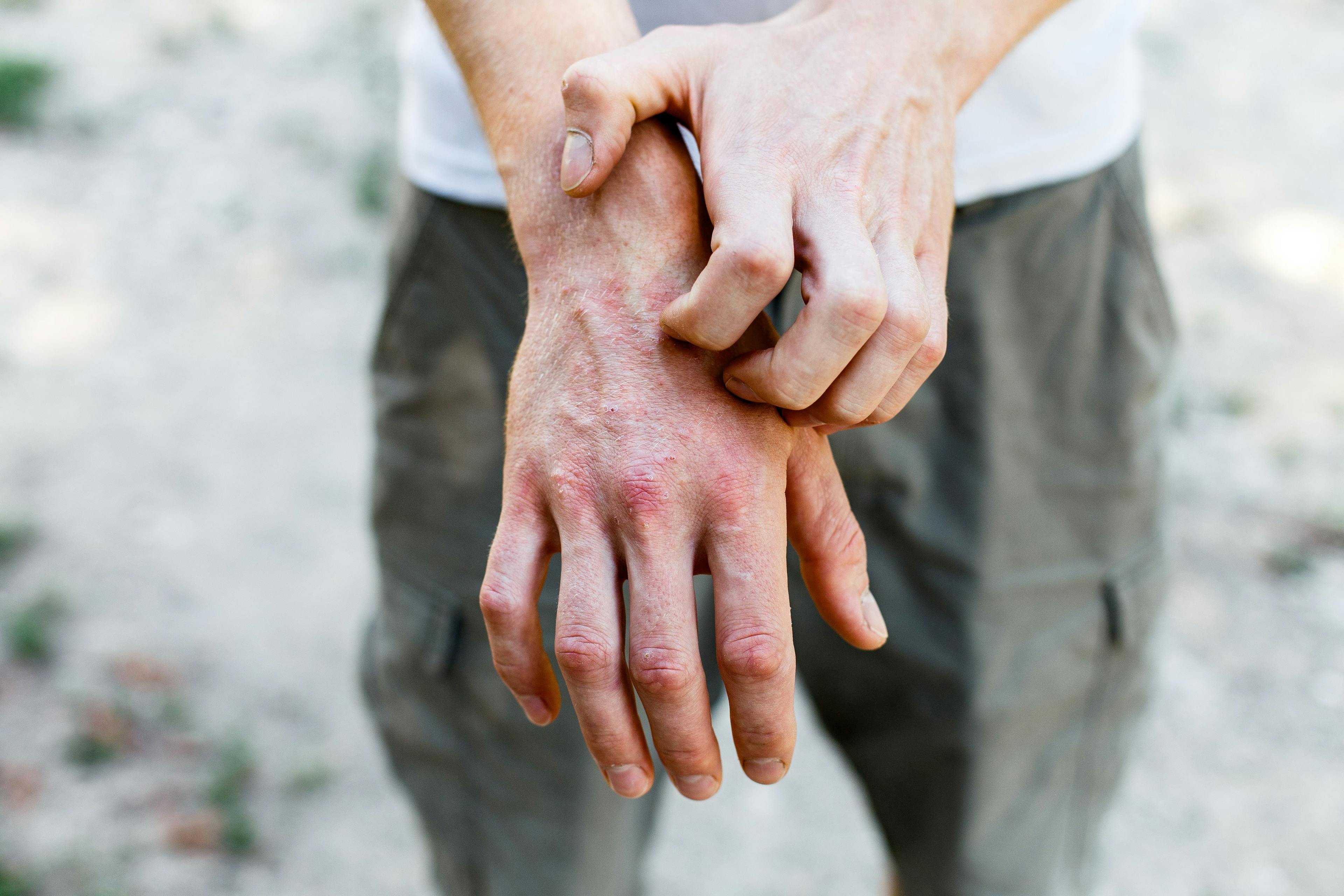 Patient scratching atopic dermatitis (AD) on hand | Image Credit: Ольга Тернавская - stock.adobe.com
