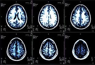 Chronic Active Lesions Associated With Poorer Outcomes in Multiple Sclerosis