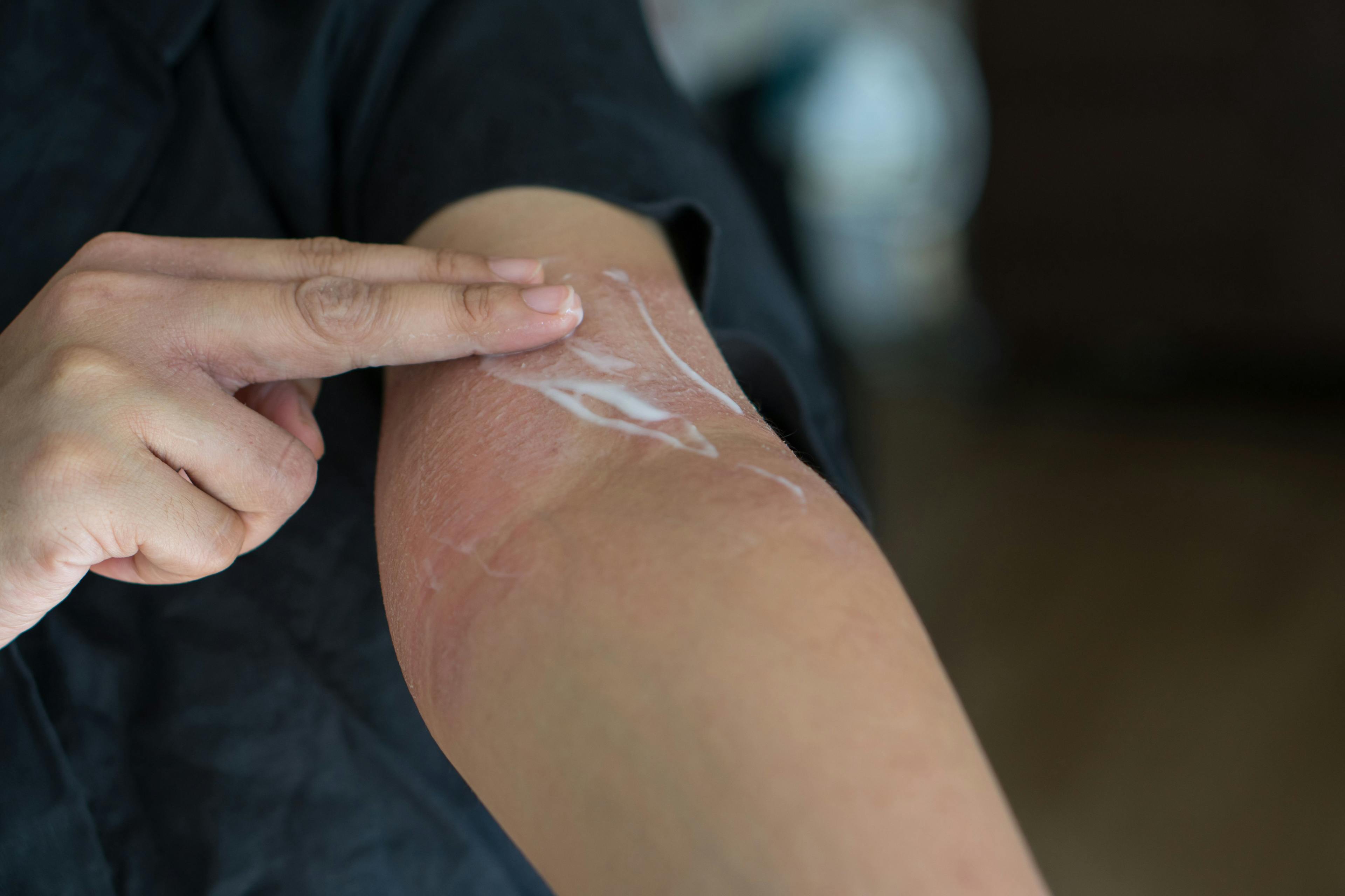 Cream applied to rash on skin | Image credit: sattahipbeach - stock.adobe.com