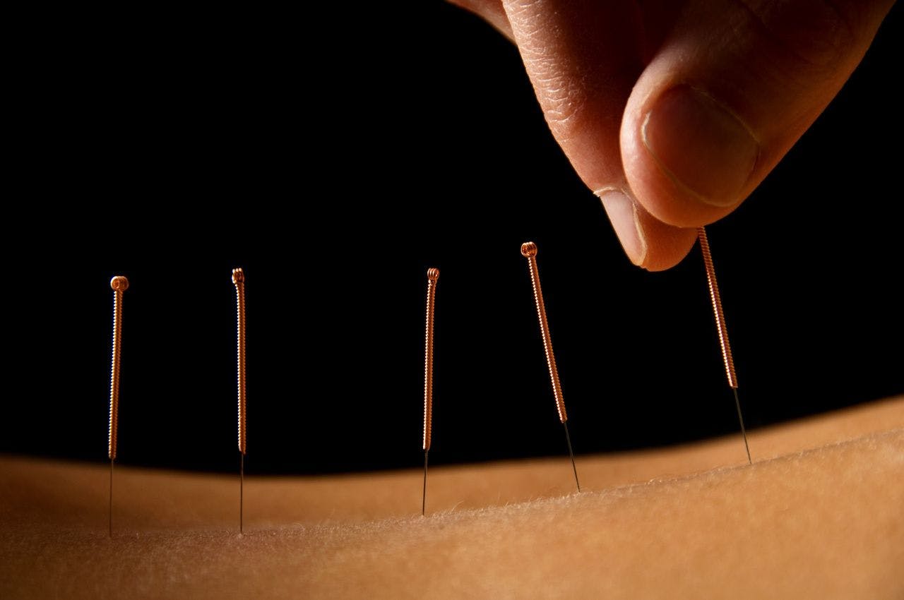 Gray Matter Volume May Indicate Efficacy of Acupuncture for Migraine
