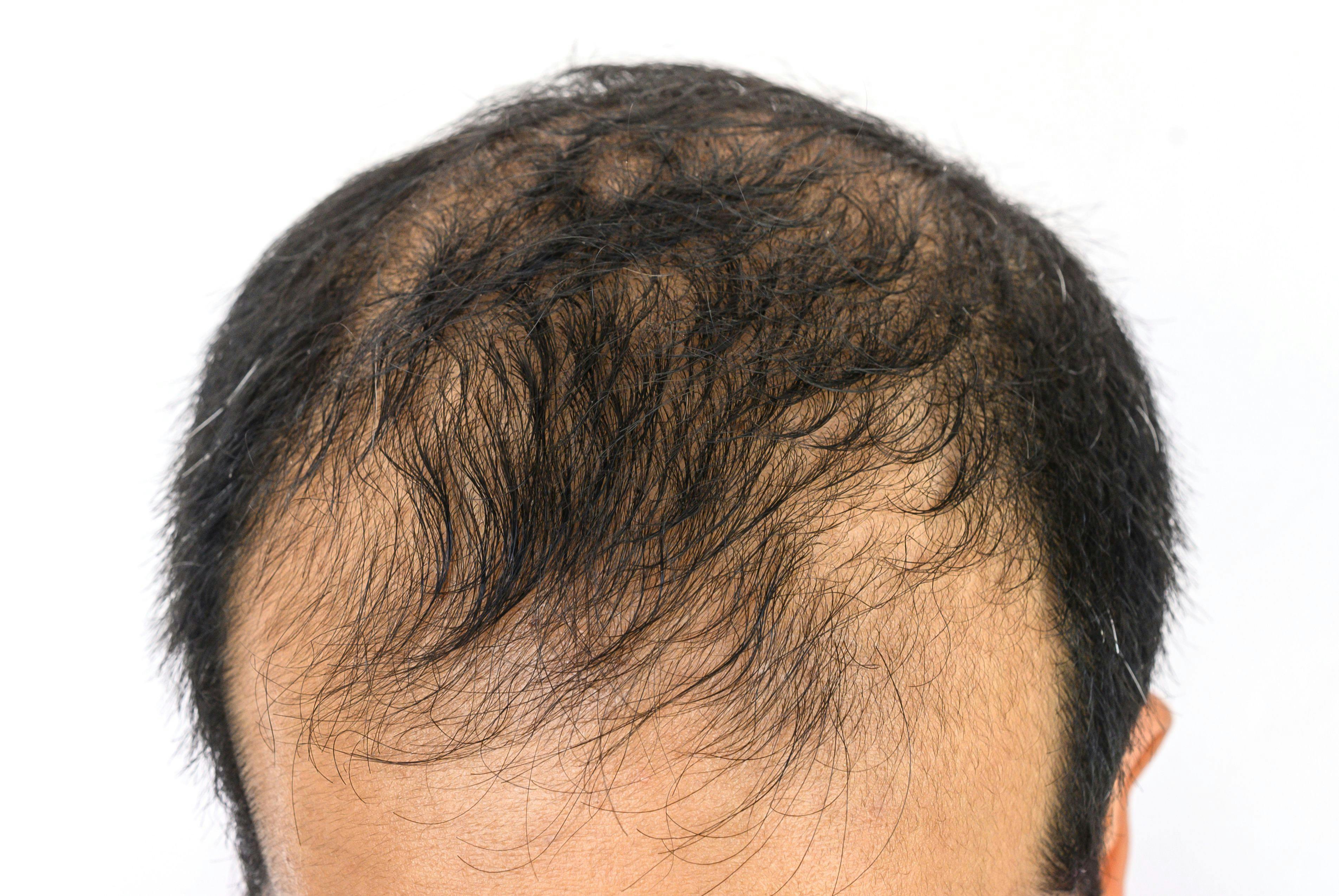 Male pattern baldness. | Image Credit: boyloso - stock.adobe.com