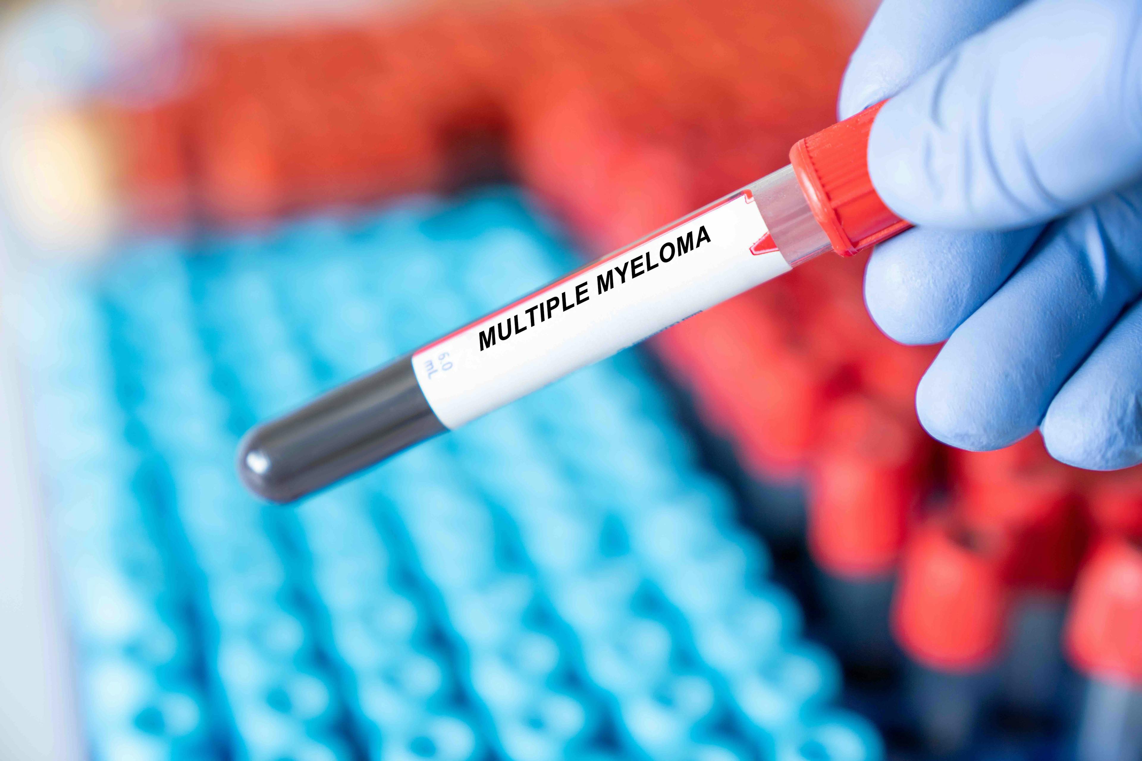 Multiple myeloma blood testing Image credit: luchschenF - stock.adobe.com