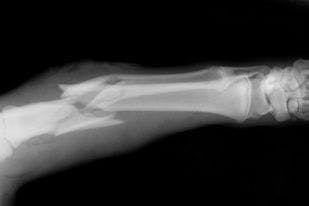 Biologic Treatment Is Associated With Better Bone Health in Patients With Psoriatic Arthritis