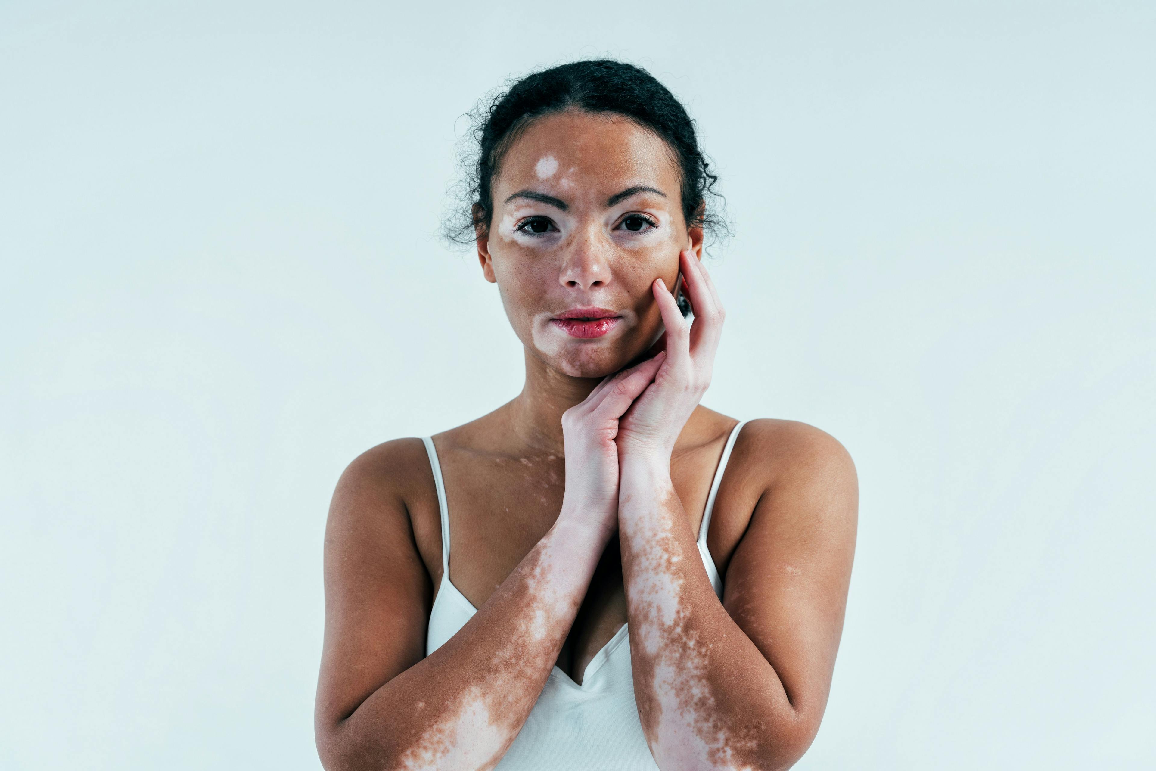 Woman with vitiligo | Image Credit: oneinchpunch - stock.adobe.com