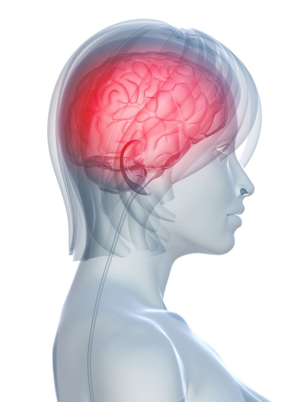 Review Explores Association Between Chronic Migraine, Suicide Ideation 