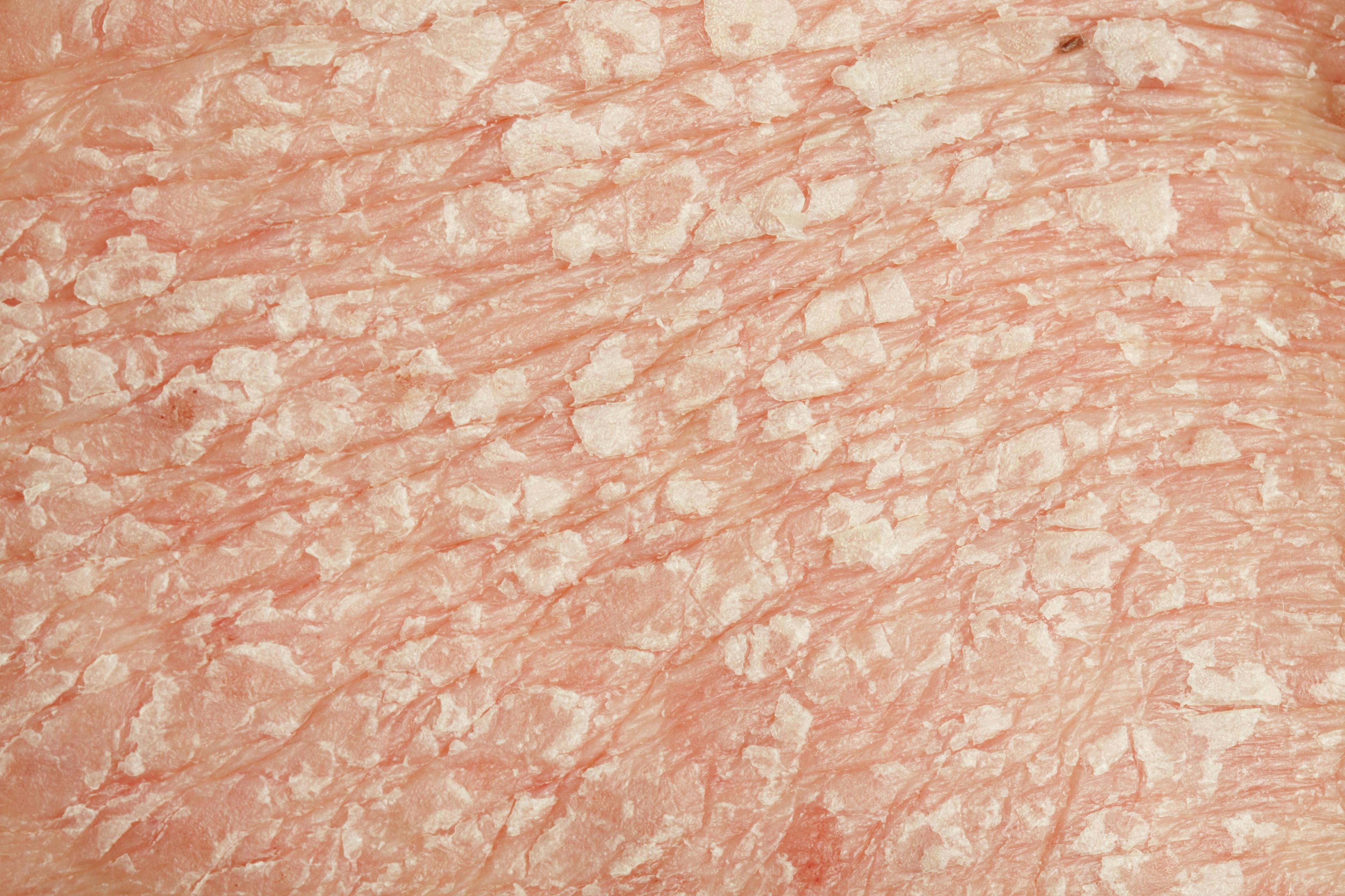 Skin affected by psoriasis