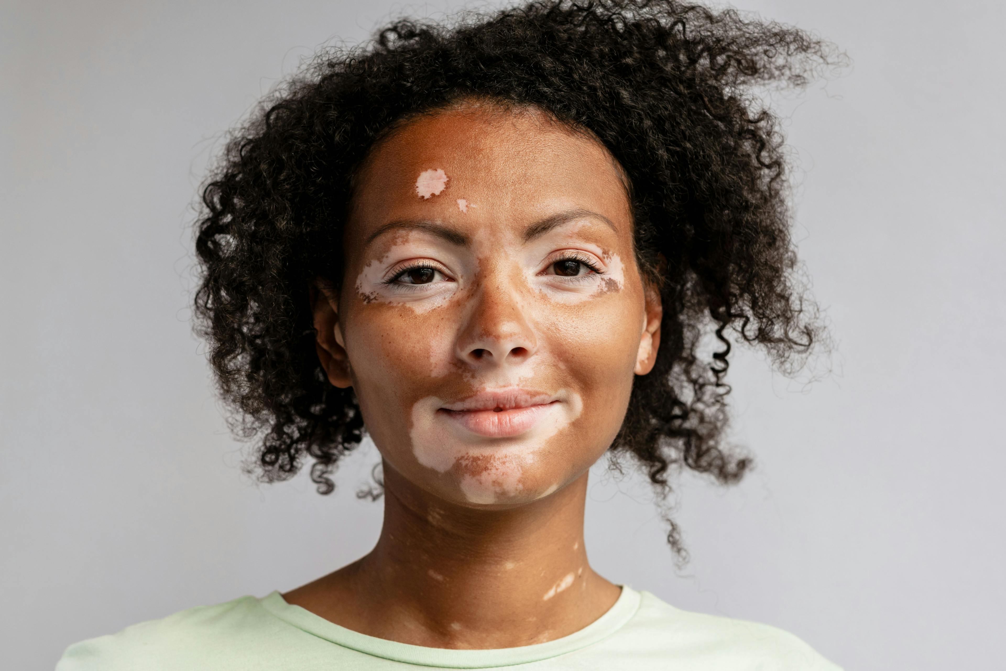 Woman with vitiligo | Image credit: Drobot Dean - stock.adobe.com