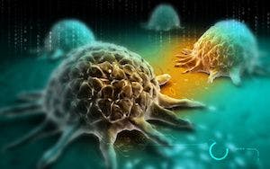 New Risk Group Model for Prostate Cancer May Lead to Better Treatment