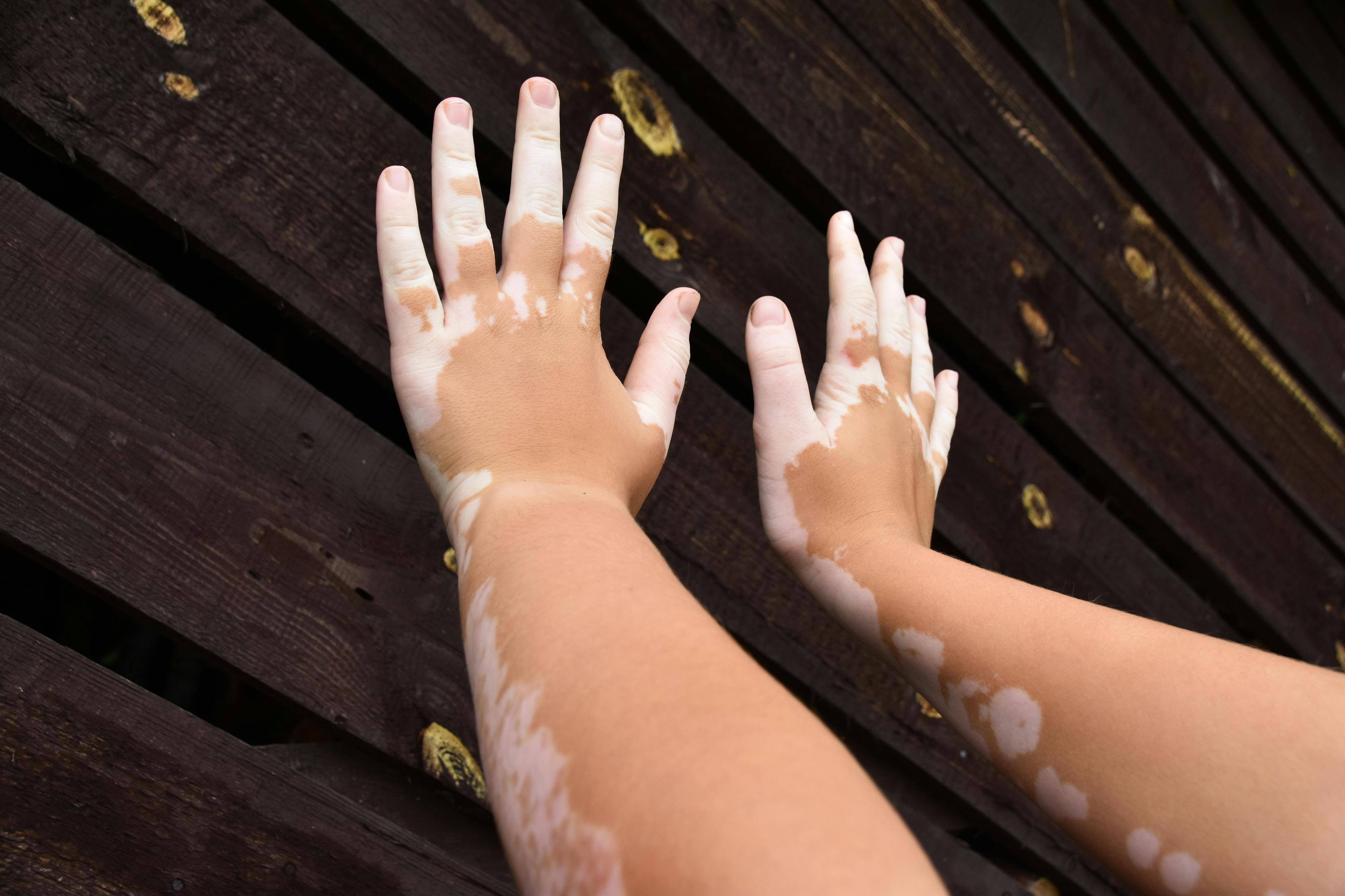 child's arms with vitiligo | Image Credit: Liga Cerina - stock.adobe.com