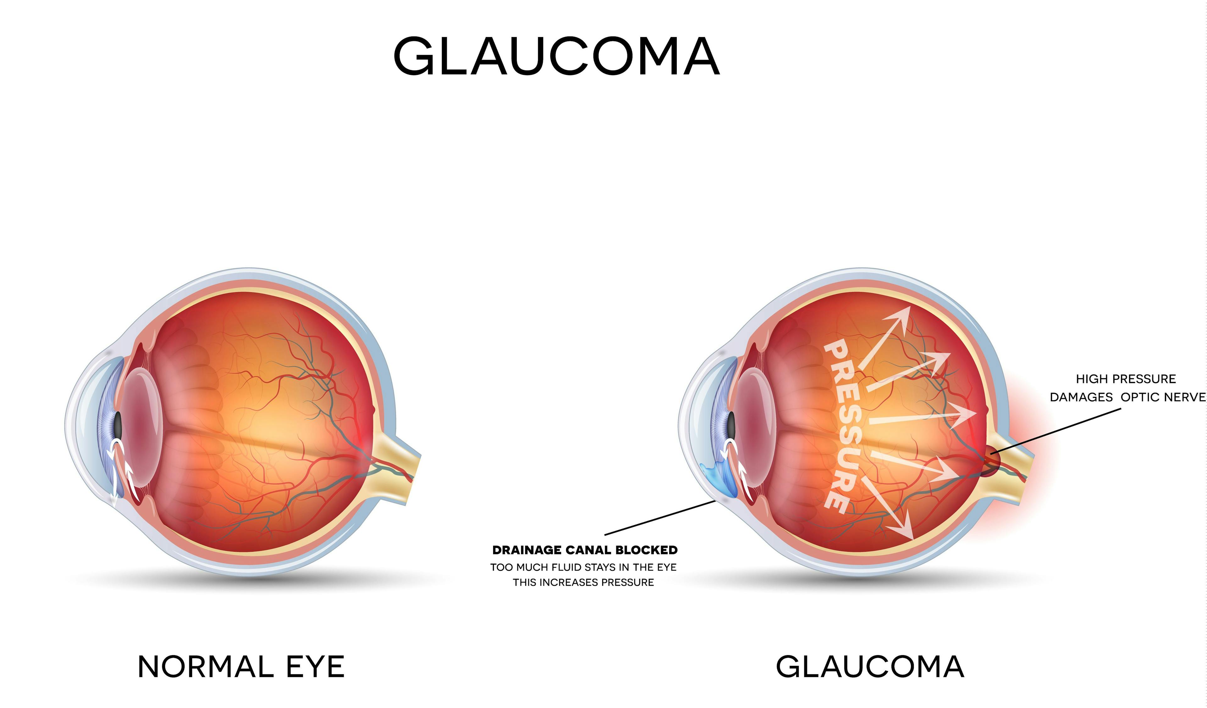Glaucoma | Image credit: reineg - stock.adobe.com
