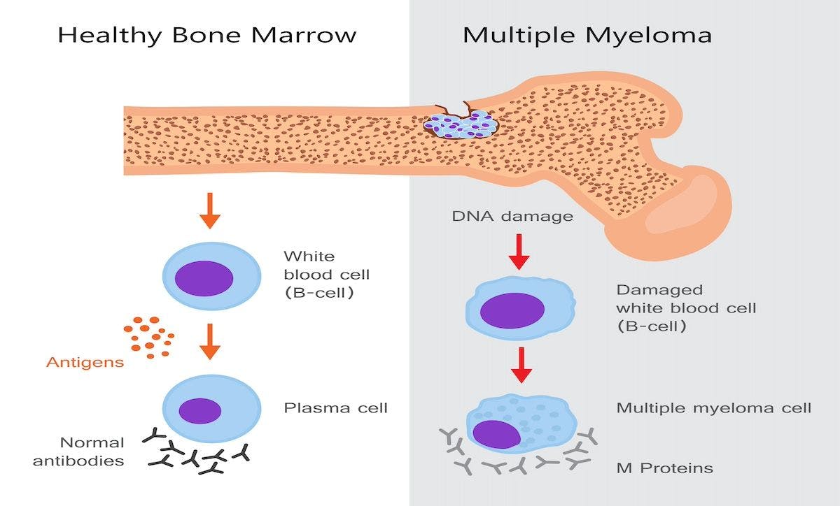 Multiple Myeloma Diagram | Image Credit: fancytapis - stock.adobe.com
