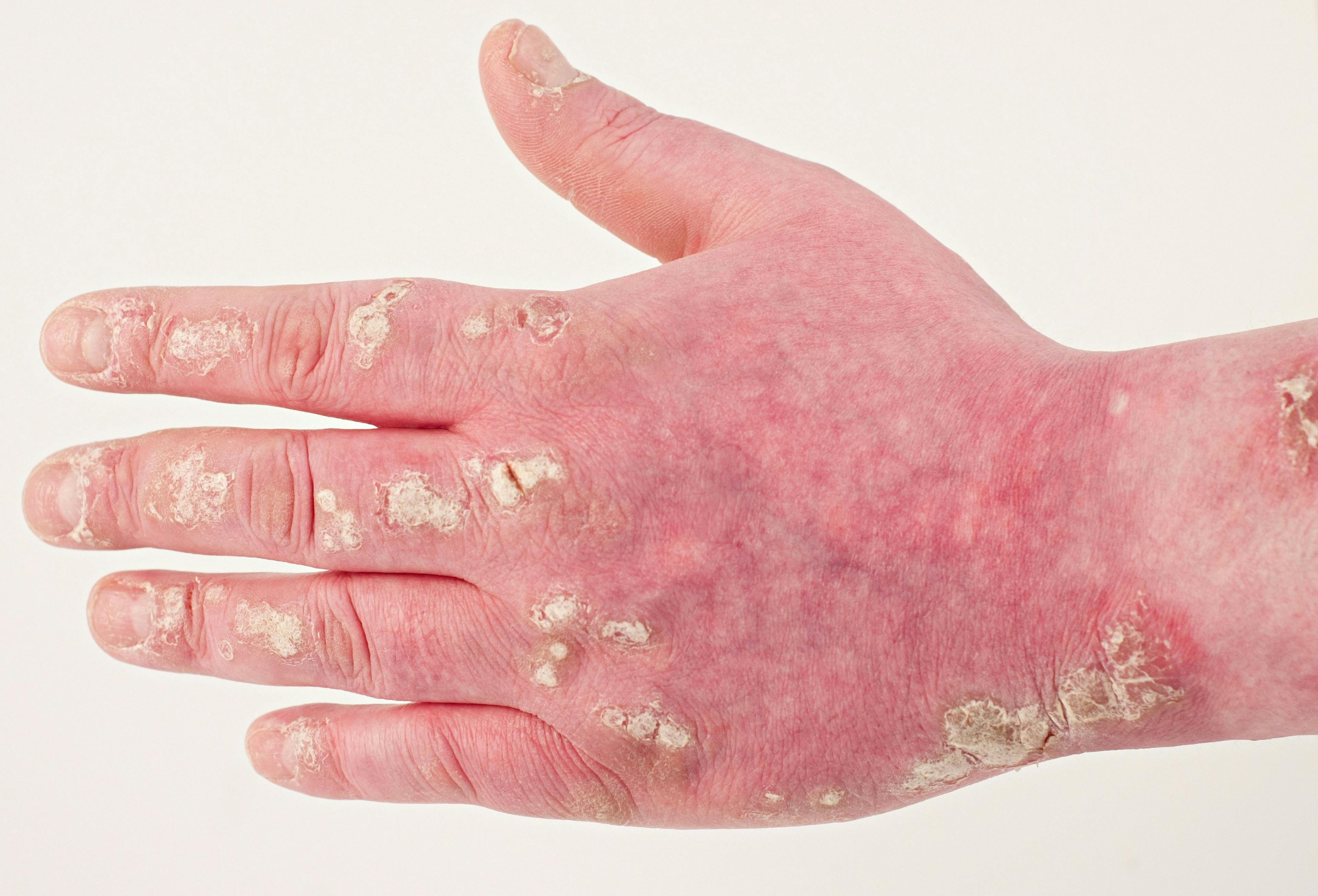 Patients With Refractory Psoriasis Helped by Combination Therapy, Case Study Finds