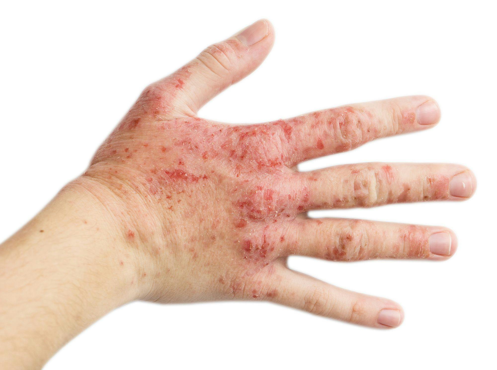 A right hand of a woman with eczema on it | Image credit: Injenerker - gettyimages.com