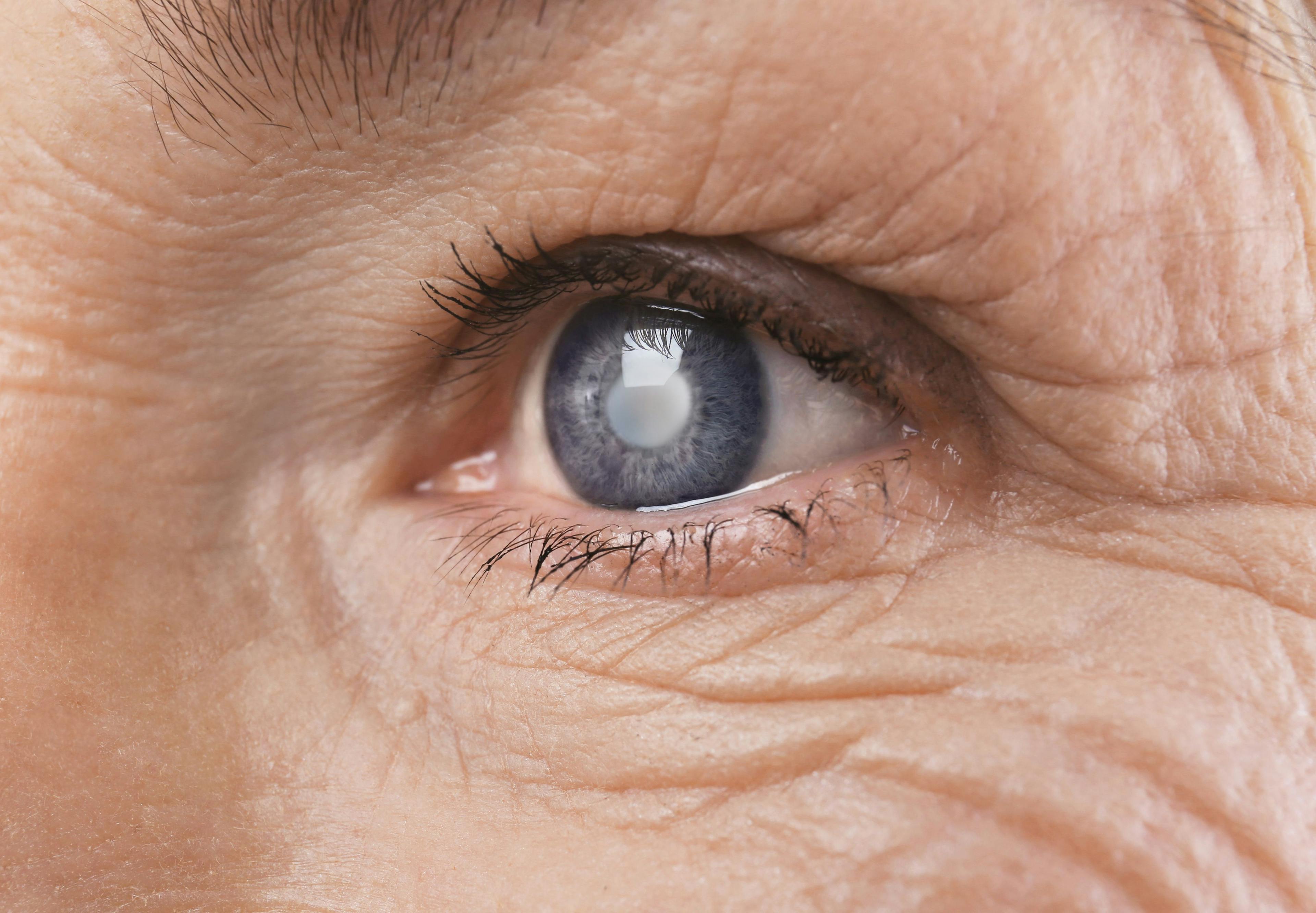 Older woman with Glaucoma | Image credit: Africa Studio - stock.adobe.com