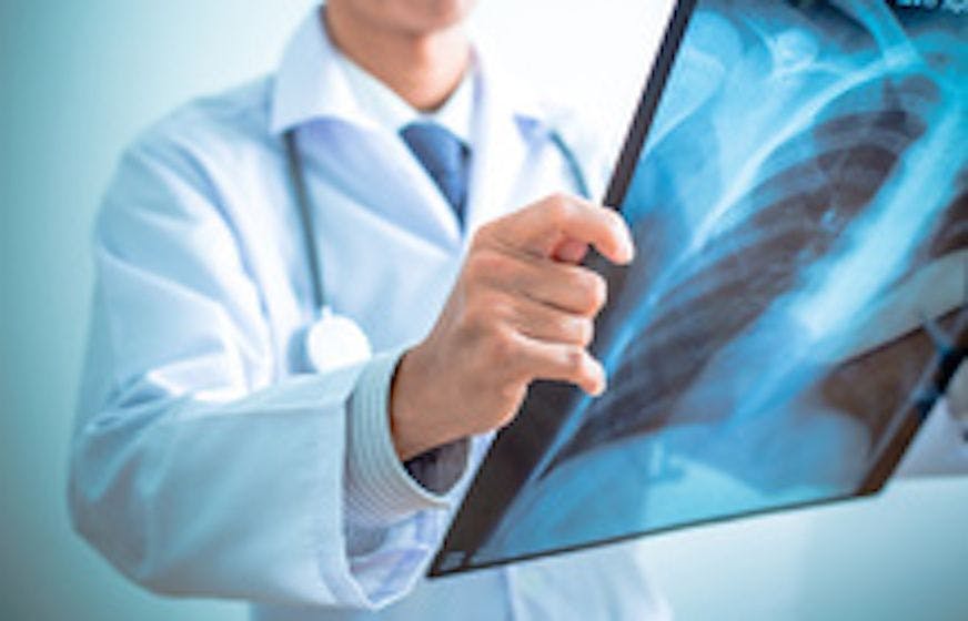 Study Finds Patient Navigation Program Increases Lung Cancer Screening Rates in Urban Setting