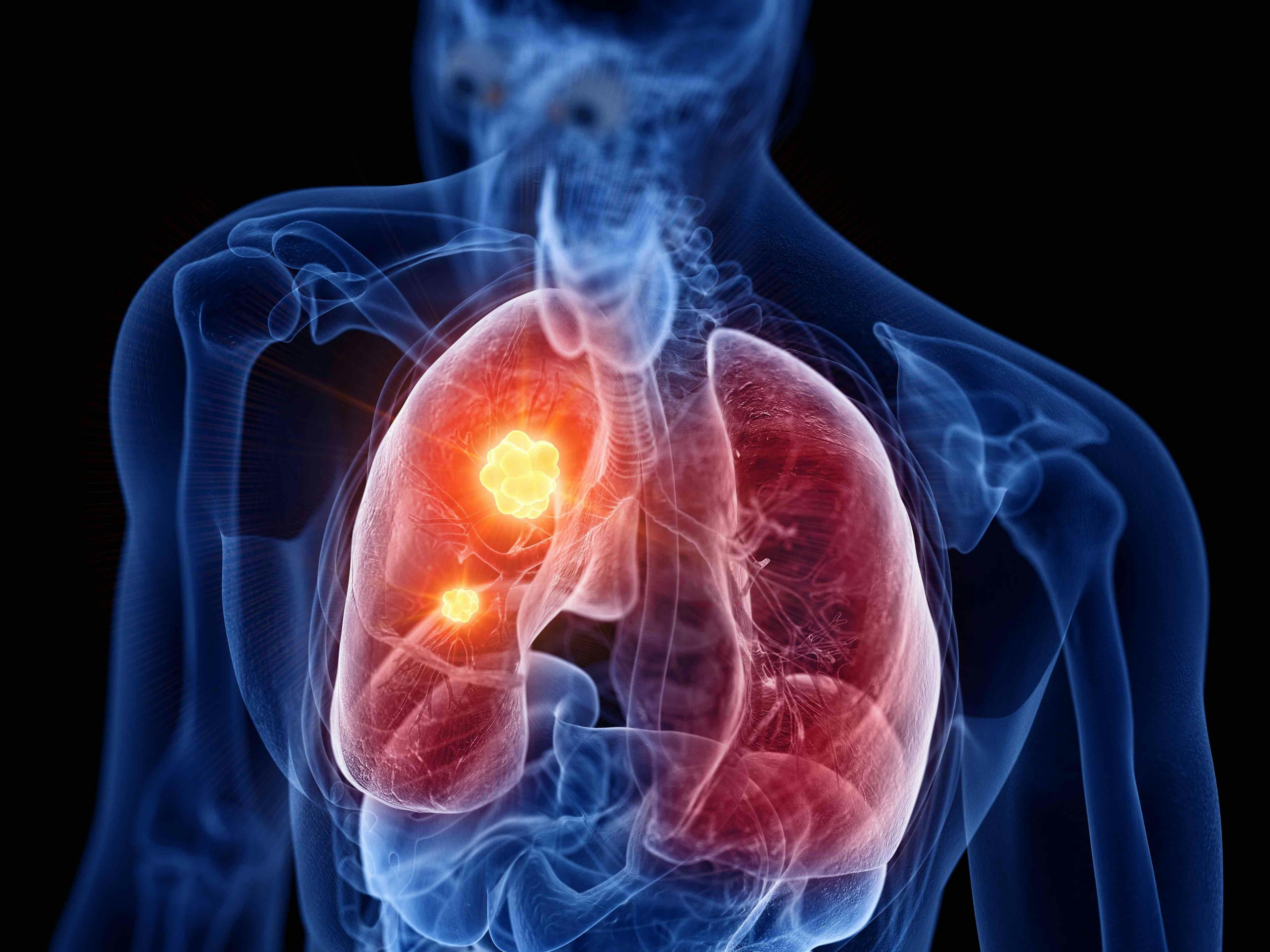 Lung cancer illustration | Image credit: SciePro - stock.adobe.com.jpg
