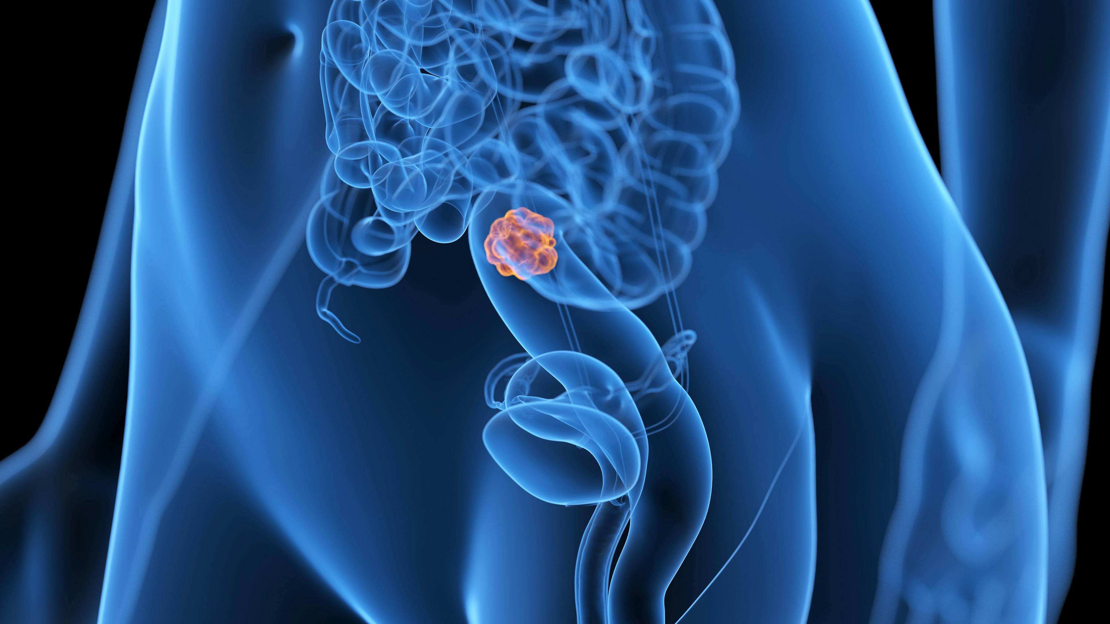Colorectal cancer | Image credit: Sebastian Kaulitzki - stock.adobe.com