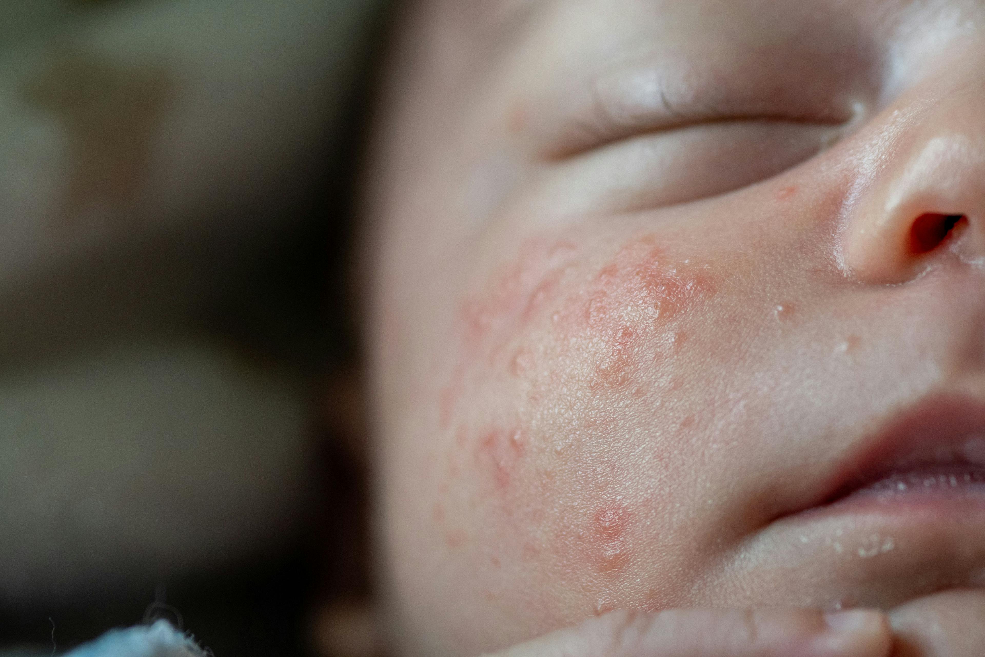 Infant with skin irritation | Image credit: Diego - stock.adobe.com