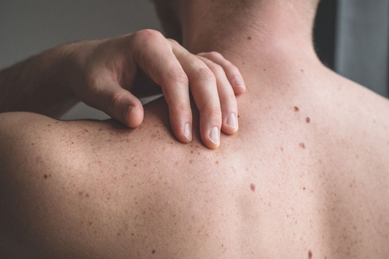 Image of person with itchy skin