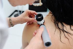 Older Age May Improve Immunotherapy Outcomes in Melanoma