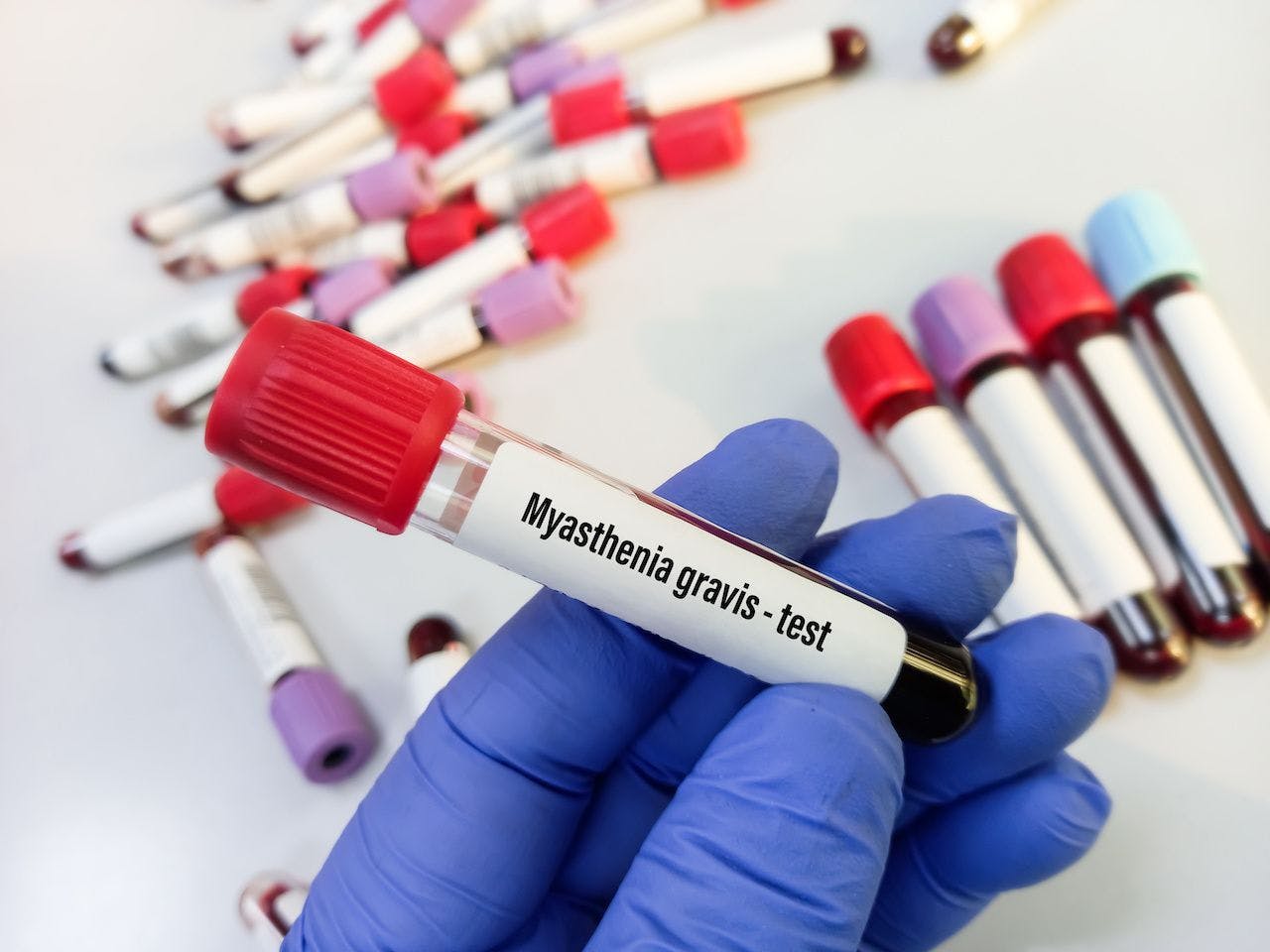 Laboratory test tubes with blood for myasthenia gravis test, diagnosis of myasthenia gravis disease, focus view: © MdBabul - stock.adobe.com
