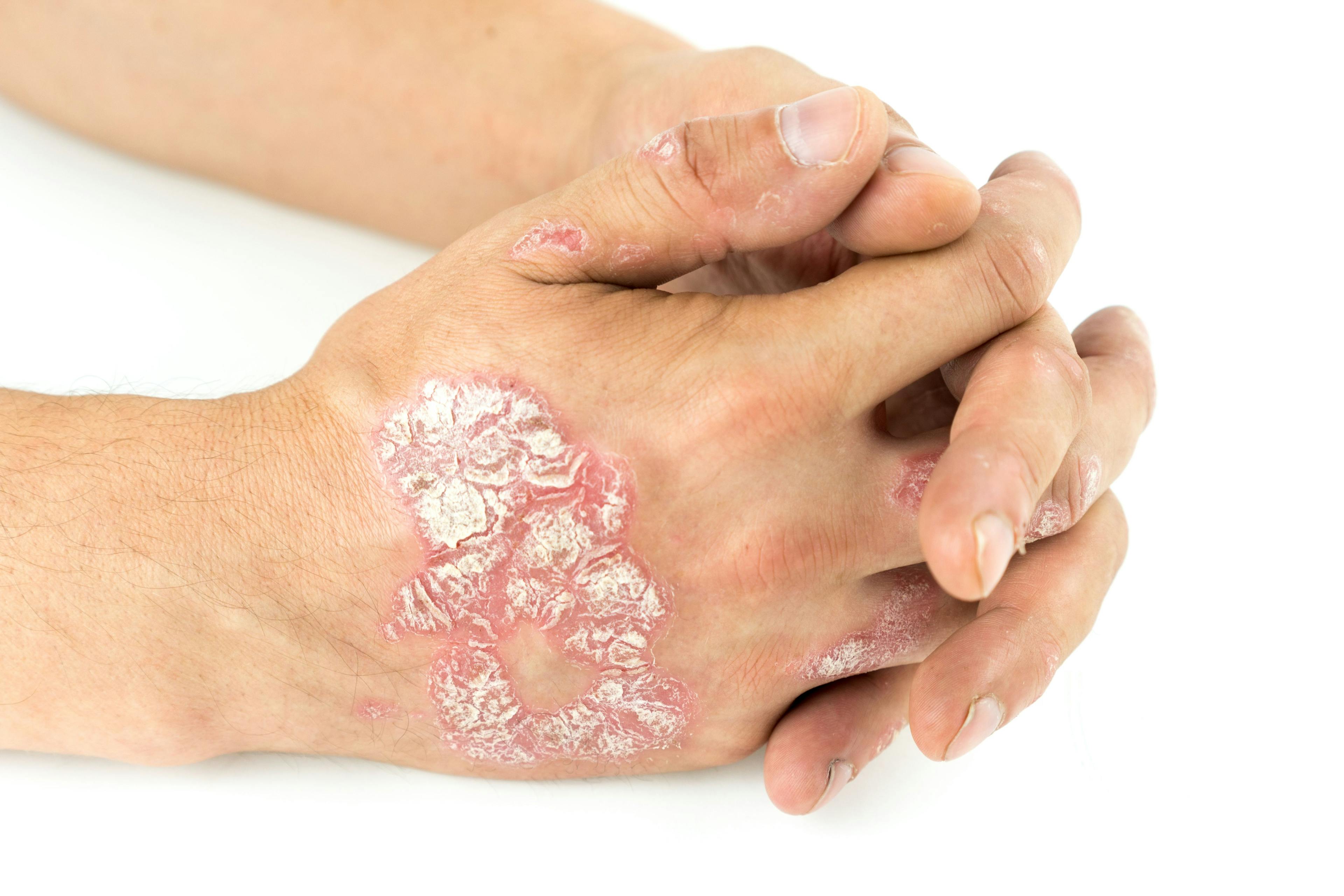 Psoriasis vulgaris on the male hands with plaque, rash and patches, isolated on white background. Autoimmune genetic disease | Image credit: Ban - stock.adobe.com