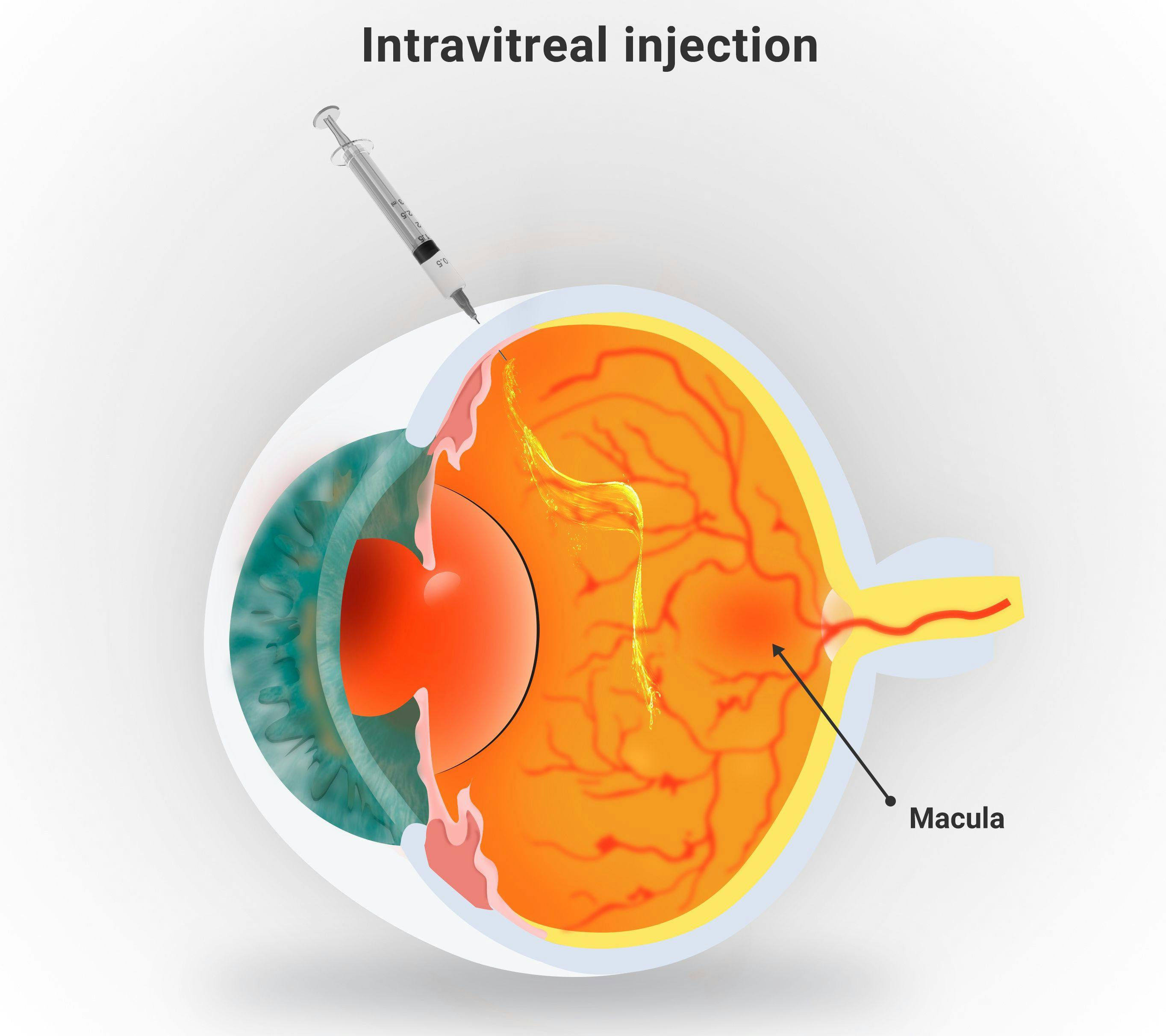 Intravitreal Injection Procedure for Macular Degeneration | Image credit: AngeloSouza - stock.adobe.com