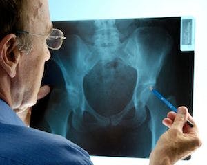 Alendronate for Glucocorticoid-Induced Osteoporosis Does Not Reduce Fracture Risk