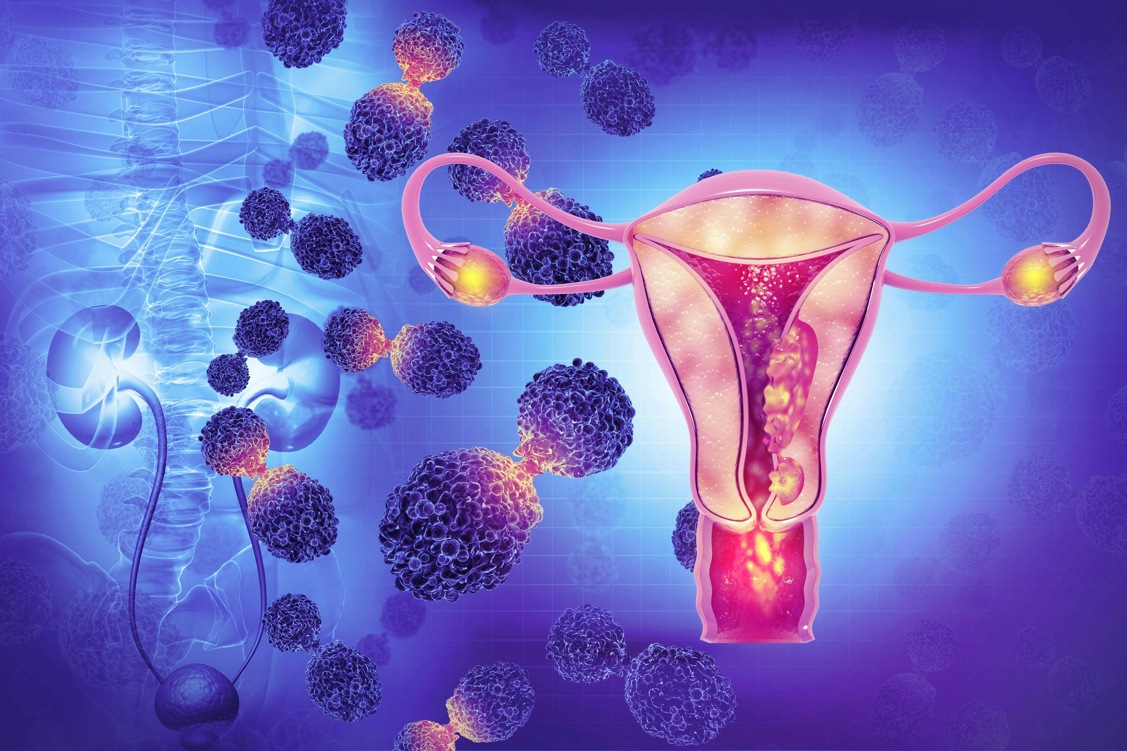 Ovarian cancer image of ovarian with cancer cells | Image credit: Crystal light - stock.adobe.com