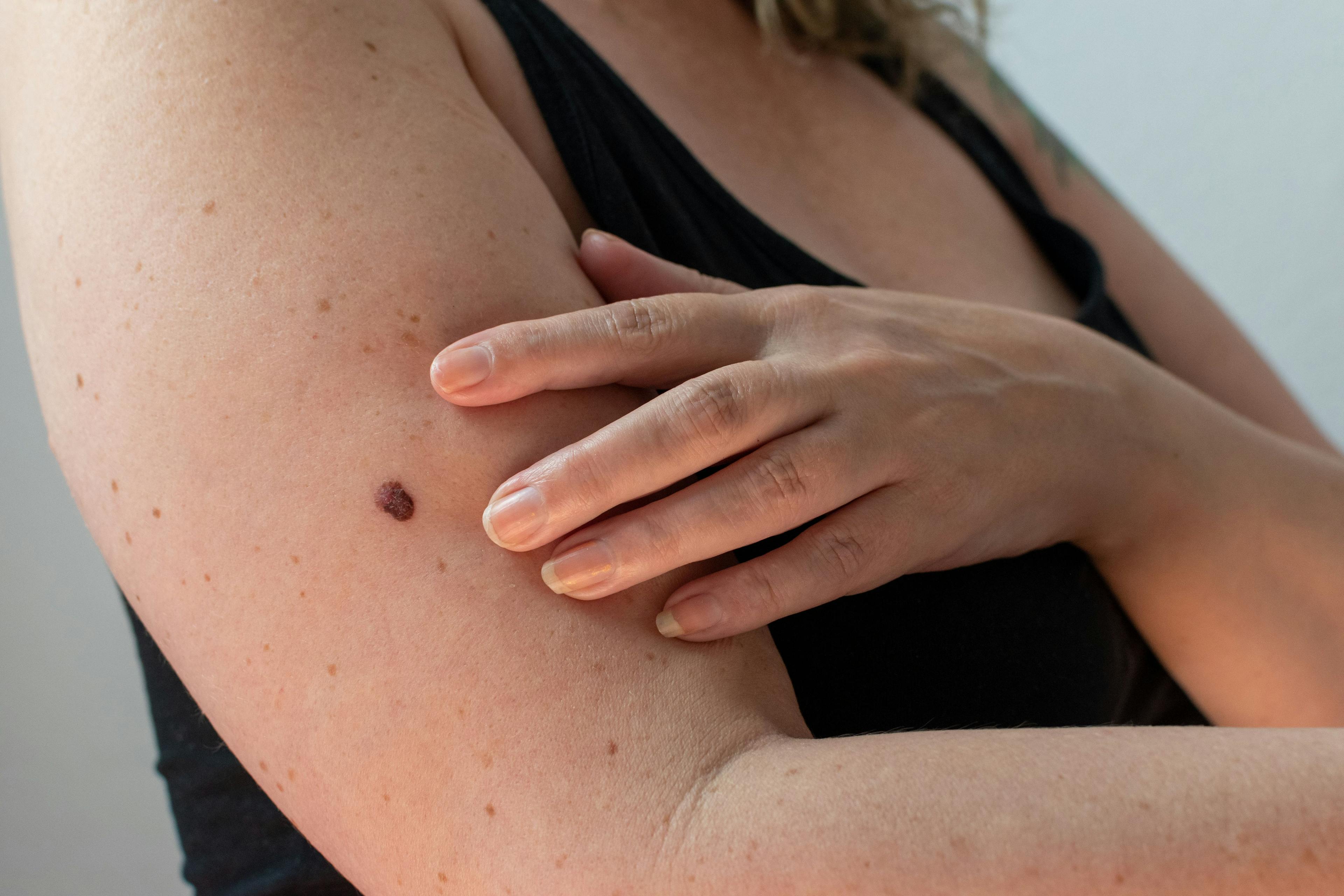 Woman Checking Skin for Signs of Melanoma | image credit: MW Photography - stock.adobe.com