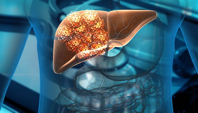 Animation of a liver with cancer cell growth | Image Credit: Rasi - stock.adobe.com