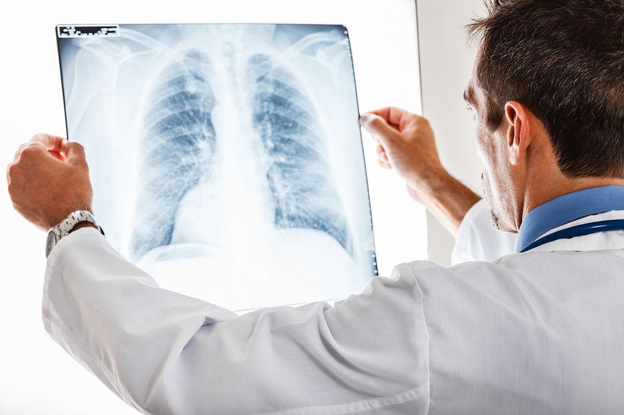 Community-Acquired Pneumonia Presents Burden for Patients With COPD