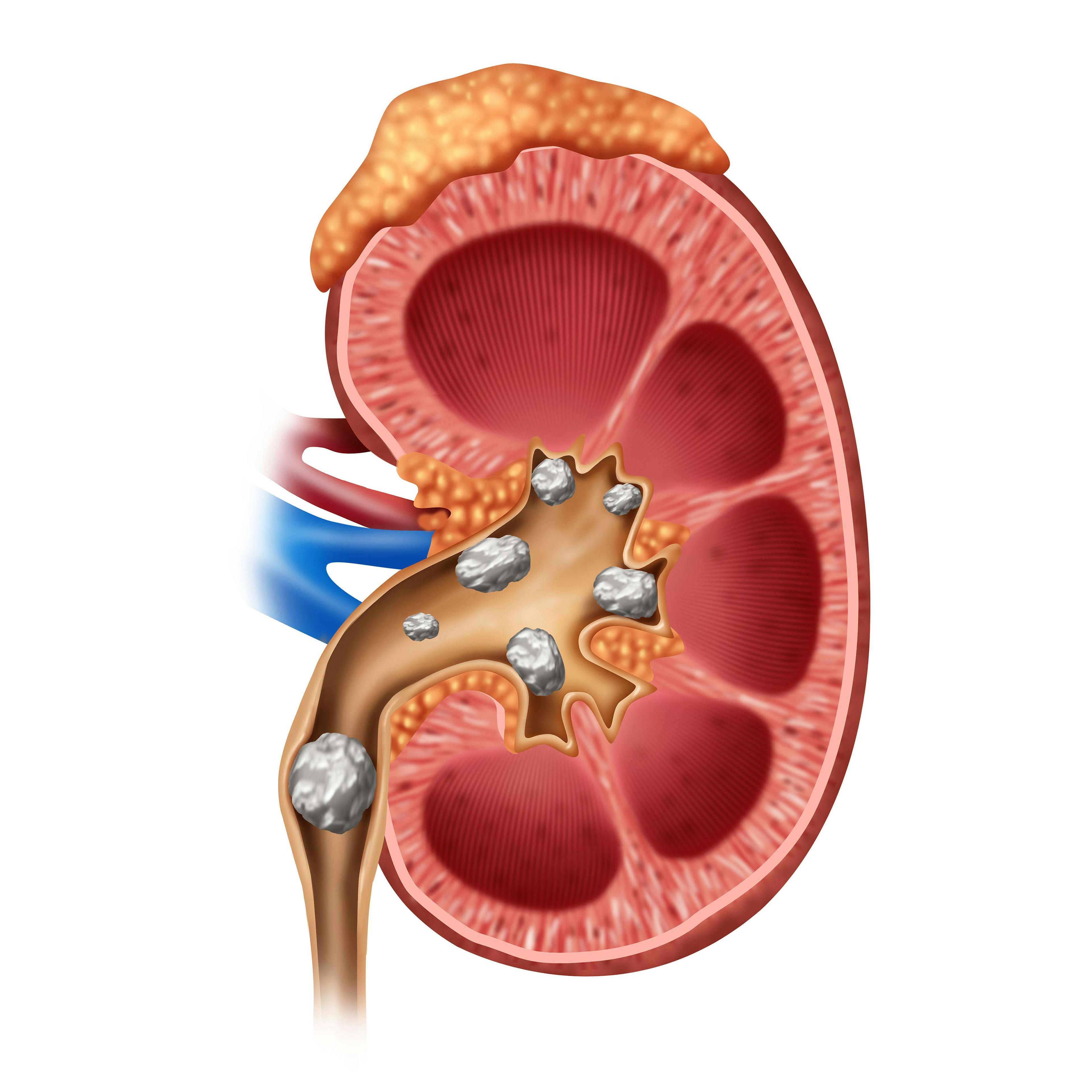 Study Illustrates Kidney Impact After COVID-19 Resolves