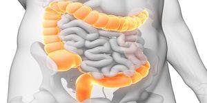 Start Screening for Colon Cancer at Age 45, Not 50, ACS Recommends