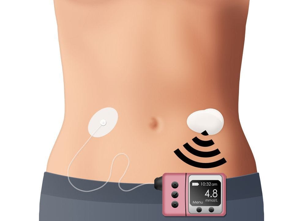 Image of a continuous glucose monitor
