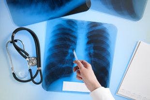 COPD Associated With Poorer Survival in Patients With NSCLC