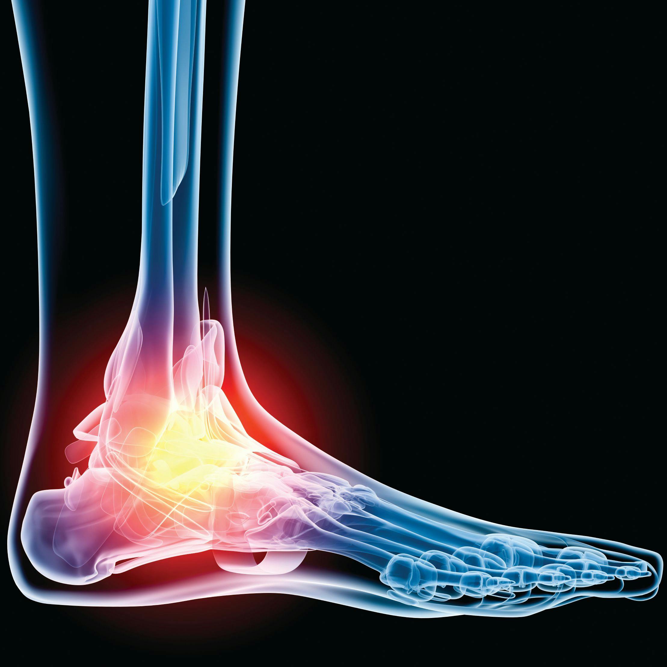 graphic of skeleton with red flare around ankle