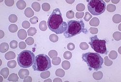 graphic of leukemic cells