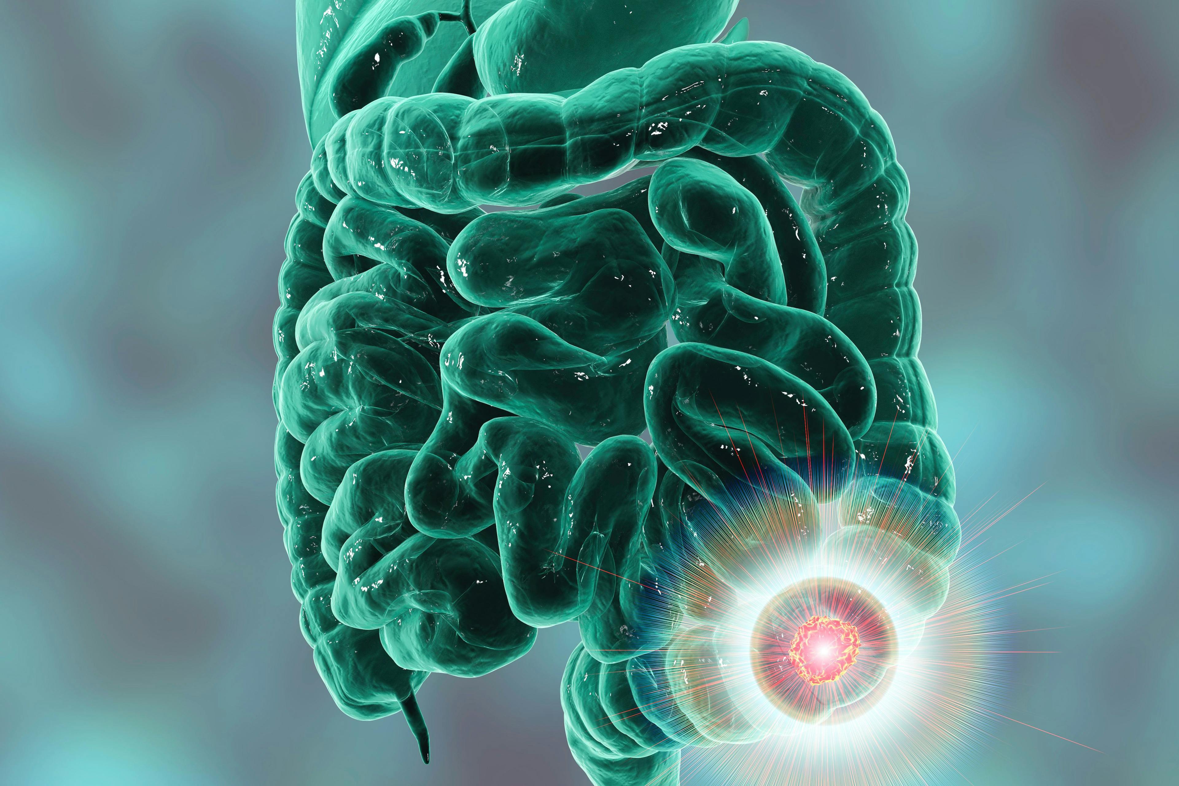Colorectal cancer awareness medical concept. Concept of cancer treatment and prevention, 3D illustration | Image credit: Dr_Microbe - stock.adobe.com