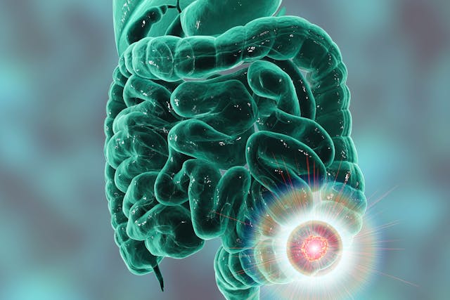 Colorectal Cancer | Image credit: Dr_Microbe - stock.adobe.com