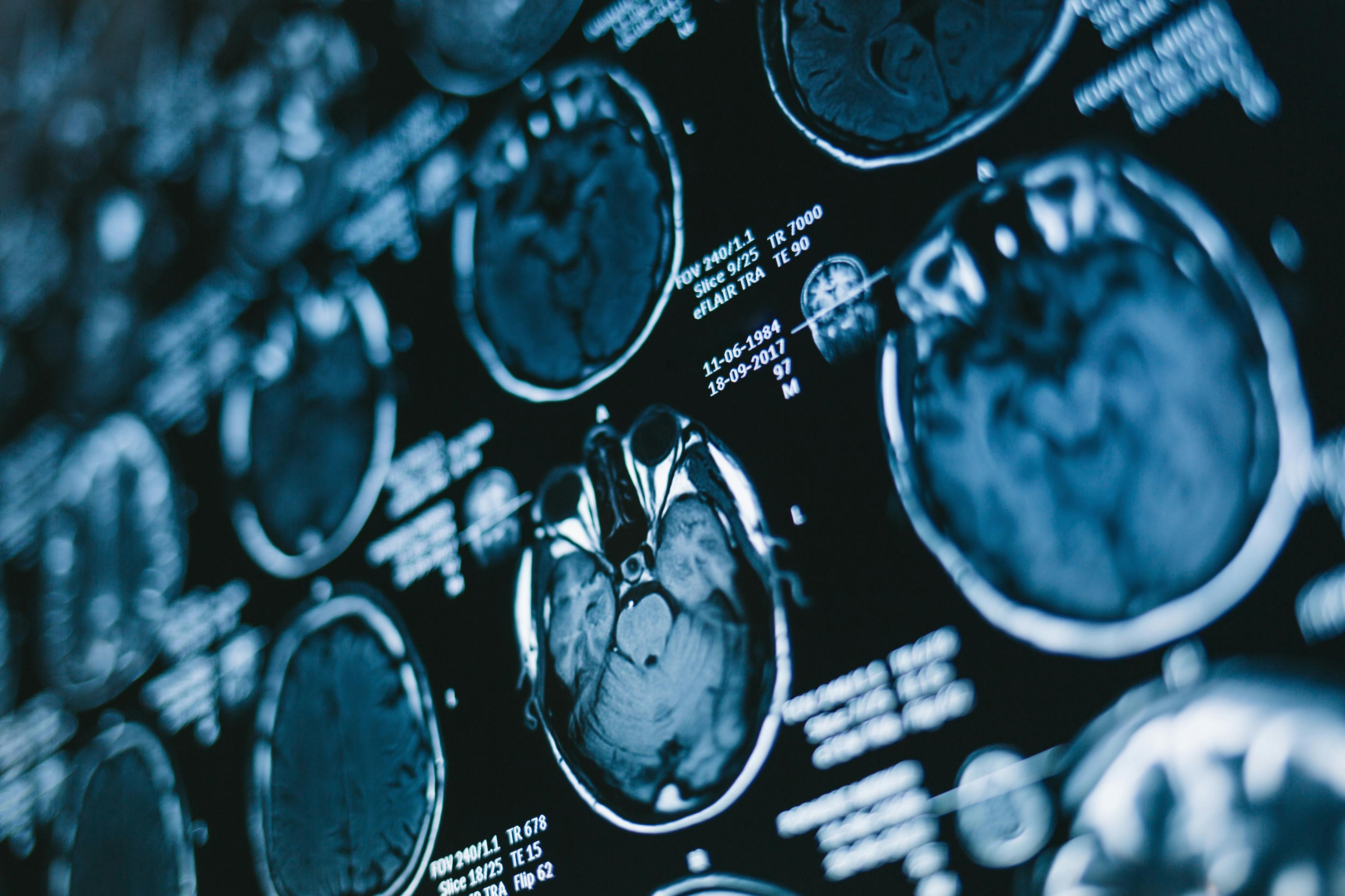 MRI Brain Scan for MS Lesions Model | image credit: yossarian6 - stock.adobe.com