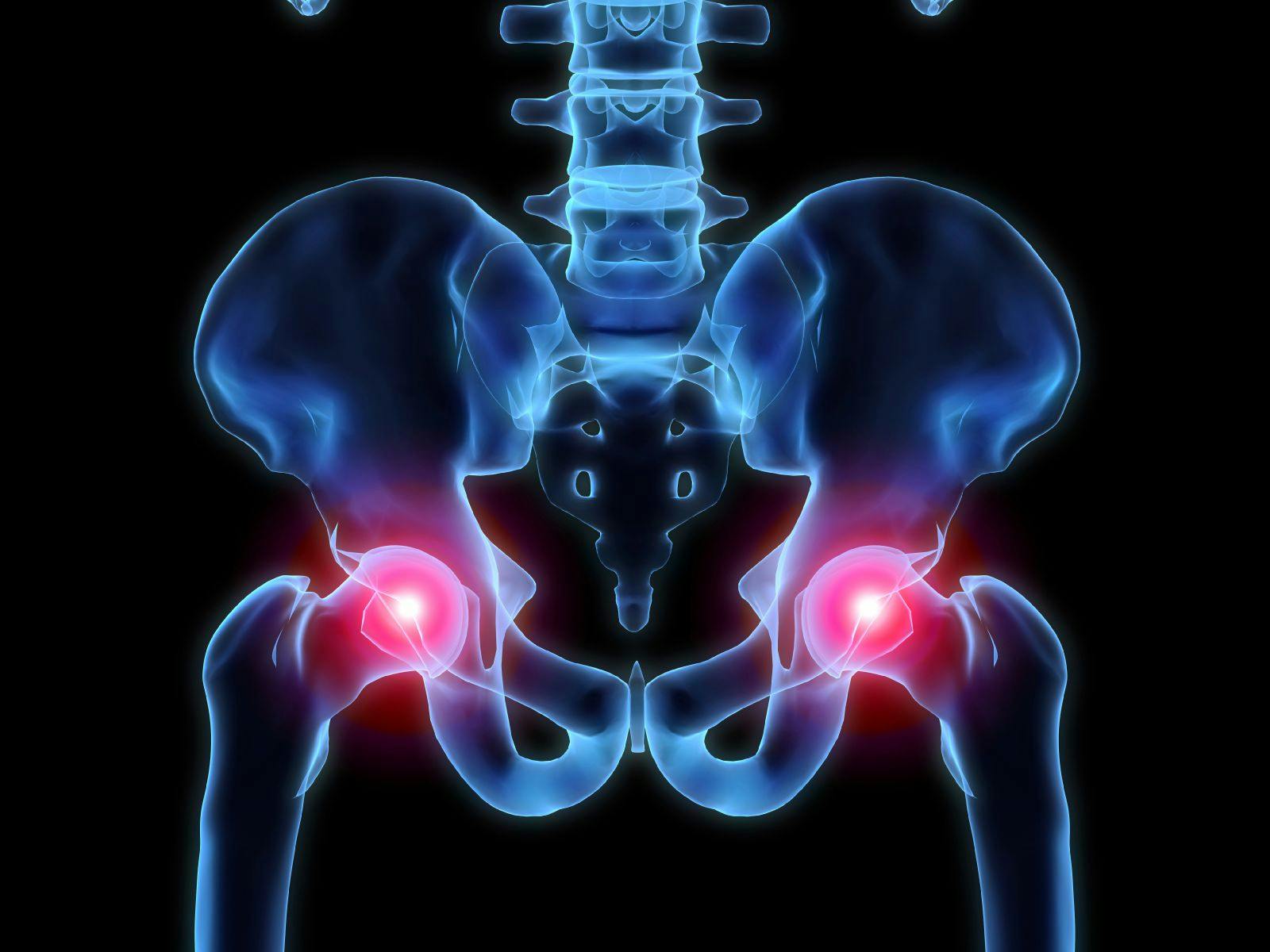  Hip Instability Progresses Most Rapidly in Patients With SMA Type 1