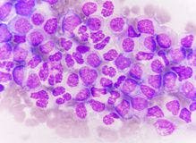 Bone marrow blast cells