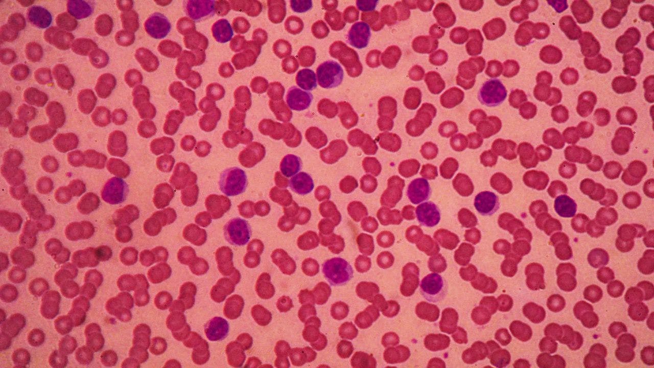 Chronic lymphocytic leukemia image