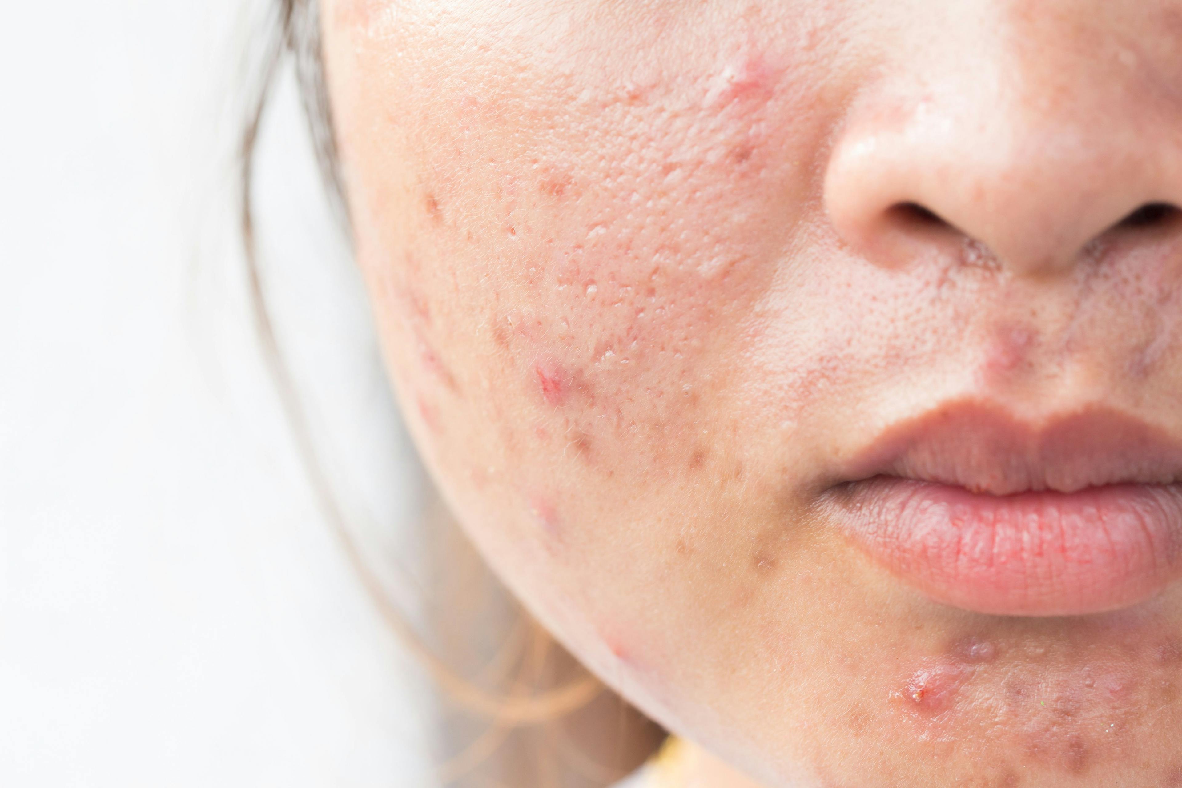 acne scarring | Image credit: frank29052515 - stock.adobe.com